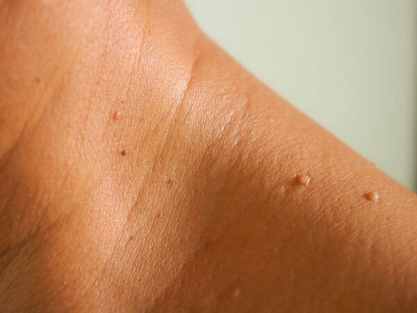 Fibroma mole: o que é, causas e tratamento