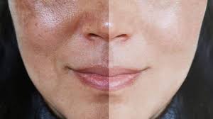 Melasma – Saúde a flor da pele