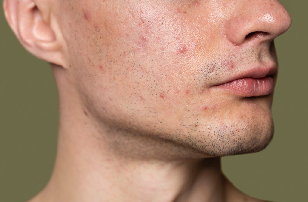 Tratamentos para Acne: Abordagens Modernas e Tradicionais